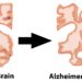 Alzheimer’ Anatomy